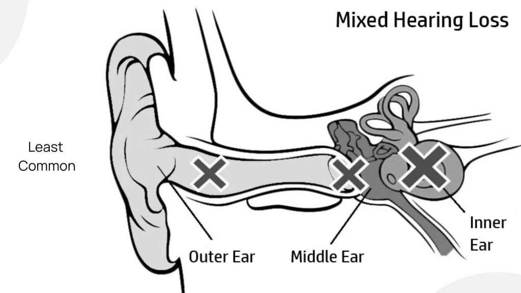 Mixed Hearing Loss