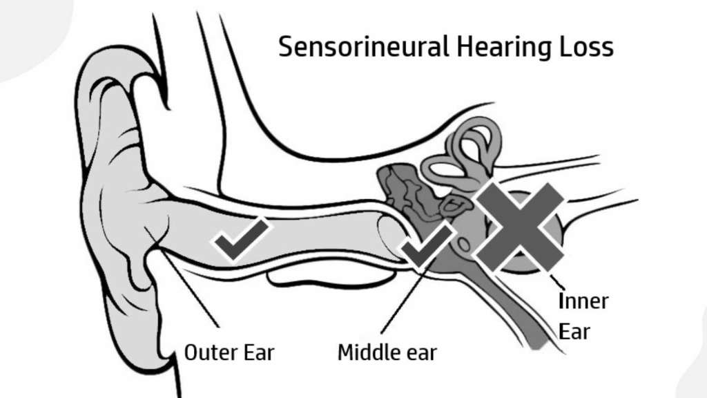 Sensorineural Hearing Loss