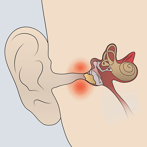 Conductive Hearing Loss