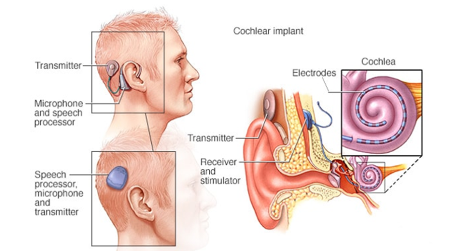 what is cochlear implant