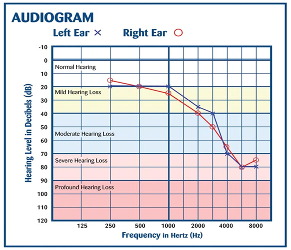 Audiogram 